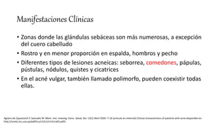 Manifestaciones Clínicas
• Zonas donde las glándulas sebáceas son más numerosas, a excepción
del cuero cabelludo
• Rostro y en menor proporción en espalda, hombros y pecho
• Diferentes tipos de lesiones acneicas: seborrea, comedones, pápulas,
pústulas, nódulos, quistes y cicatrices
• En el acné vulgar, también llamado polimorfo, pueden coexistir todas
ellas.
Agüero de Zaputovich F, Samudio M .Mem. Inst. Investig. Cienc. Salud, Vol. 13(1) Abril 2020: 7-16 [articulo en internet] Clinical characteristics of patients with acne disponible en:
http://scielo.iics.una.py/pdf/iics/v13n1/v13n1a03.pdf3.
 