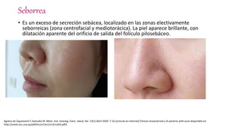 Seborrea
• Es un exceso de secreción sebácea, localizado en las zonas electivamente
seborreicas (zona centrofacial y mediotorácica). La piel aparece brillante, con
dilatación aparente del orificio de salida del folículo pilosebáceo.
Agüero de Zaputovich F, Samudio M .Mem. Inst. Investig. Cienc. Salud, Vol. 13(1) Abril 2020: 7-16 [articulo en internet] Clinical characteristics of patients with acne disponible en:
http://scielo.iics.una.py/pdf/iics/v13n1/v13n1a03.pdf3.
 