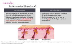 Comedón
• Lesión característica del acné
comedón cerrado
• pequeña elevación de la superficie de la piel,
dura y de color blanquecino amarillento
• debido a una salida de los lípidos del sebo a
través del folículo y a una colonización de P.
acnes se producen lesiones inflamatorias
(pápulas, pústulas, nódulos y quistes).
comedón abierto
• vulgarmente llamado espinilla, pequeña
elevación dura y de color negro
• El comedón abierto, a no ser que se
manipule, no suele dar lugar a lesiones
inflamatorias.
Agüero de Zaputovich F, Samudio M .Mem. Inst. Investig. Cienc. Salud, Vol. 13(1) Abril 2020: 7-16 [articulo en internet] Clinical characteristics of patients with acne disponible en:
http://scielo.iics.una.py/pdf/iics/v13n1/v13n1a03.pdf3.
 