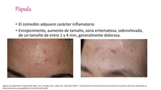 Pápula
• El comedón adquiere carácter inflamatorio
• Enrojecimiento, aumento de tamaño, zona eritematosa, sobreelevada,
de un tamaño de entre 1 y 4 mm, generalmente dolorosa.
Agüero de Zaputovich F, Samudio M .Mem. Inst. Investig. Cienc. Salud, Vol. 13(1) Abril 2020: 7-16 [articulo en internet] Clinical characteristics of patients with acne disponible en:
http://scielo.iics.una.py/pdf/iics/v13n1/v13n1a03.pdf3.
 