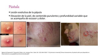 Pústula
 Lesión evolutiva de la pápula
 Elevación de la piel, de contenido purulento y profundidad variable que
se acompaña de escozor y dolor.
Agüero de Zaputovich F, Samudio M .Mem. Inst. Investig. Cienc. Salud, Vol. 13(1) Abril 2020: 7-16 [articulo en internet] Clinical characteristics of patients with acne disponible en:
http://scielo.iics.una.py/pdf/iics/v13n1/v13n1a03.pdf3.
 