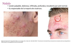 Nódulo
• Lesión palpable, dolorosa, infiltrada, profunda y recubierta por piel normal.
• Es responsable de la mayoría de cicatrices.
Agüero de Zaputovich F, Samudio M .Mem. Inst. Investig. Cienc. Salud, Vol. 13(1) Abril 2020: 7-16 [articulo en internet] Clinical characteristics of patients with acne disponible en:
http://scielo.iics.una.py/pdf/iics/v13n1/v13n1a03.pdf3.
 