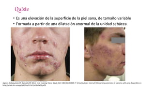 Quiste
• Es una elevación de la superficie de la piel sana, de tamaño variable
• Formada a partir de una dilatación anormal de la unidad sebácea
Agüero de Zaputovich F, Samudio M .Mem. Inst. Investig. Cienc. Salud, Vol. 13(1) Abril 2020: 7-16 [articulo en internet] Clinical characteristics of patients with acne disponible en:
http://scielo.iics.una.py/pdf/iics/v13n1/v13n1a03.pdf3.
 
