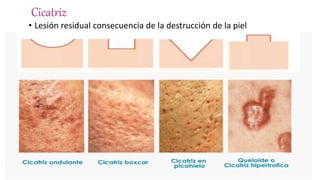 Cicatriz
• Lesión residual consecuencia de la destrucción de la piel
• Puede ser atrófica, hipertrófica o queloidea.
Agüero de Zaputovich F, Samudio M .Mem. Inst. Investig. Cienc. Salud, Vol. 13(1) Abril 2019: 7-16 [articulo en internet] Clinical characteristics of patients with acne disponible en:
http://scielo.iics.una.py/pdf/iics/v13n1/v13n1a03.pdf3.
 