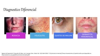 Diagnostico Diferencial
ROSACEA FOLICULITIS QUISTES DE MILIUM
DERMATITIS
PERIORIFICIAL
Agüero de Zaputovich F, Samudio M .Mem. Inst. Investig. Cienc. Salud, Vol. 13(1) Abril 2020: 7-16 [articulo en internet] Clinical characteristics of patients with acne disponible en:
http://scielo.iics.una.py/pdf/iics/v13n1/v13n1a03.pdf3.
 