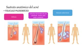 Sustrato anatómico del acné
• FOLICULO PILOSEBÁCEO
Vellosos
Folículos terminales de piel
cabelluda , barba, pelo
axilar y pubiano
Folículos seborreicos
 