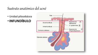 Sustrato anatómico del acné
• Unidad pilosebácea
• INFUNDÍBULO
 