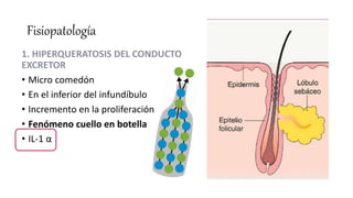 Fisiopatología
1. HIPERQUERATOSIS DEL CONDUCTO
EXCRETOR
• Micro comedón
• En el inferior del infundíbulo
• Incremento en la proliferación
• Fenómeno cuello en botella
• IL-1 α
 