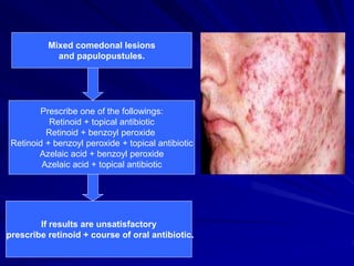 Mixed comedonal lesions
and papulopustules.
Prescribe one of the followings:
Retinoid + topical antibiotic
Retinoid + benzoyl peroxide
Retinoid + benzoyl peroxide + topical antibiotic
Azelaic acid + benzoyl peroxide
Azelaic acid + topical antibiotic
If results are unsatisfactory
prescribe retinoid + course of oral antibiotic.
 