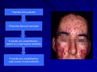 Papules and pustules
Prescribe Benzoyl peroxide
If results are unsatisfactory,
switch to or add topical antibiotic
If results are unsatisfactory
add course of oral antibiotic.
 