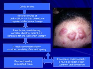 Cystic lesions
Prescribe course of
oral antibiotic + mixed comedonal
papulopustular topical therapy.
If results are unsatisfactory,
consider wheather patient is a
candidate for oral isotretinoin therapy.
If results are unsatisfactory
consider possibility of endocrinopathy
If endocrinopathy
is identified, Treat.
If no sign of endocrinopathy
is found, consider repeat
course of oral isotretinoin
 