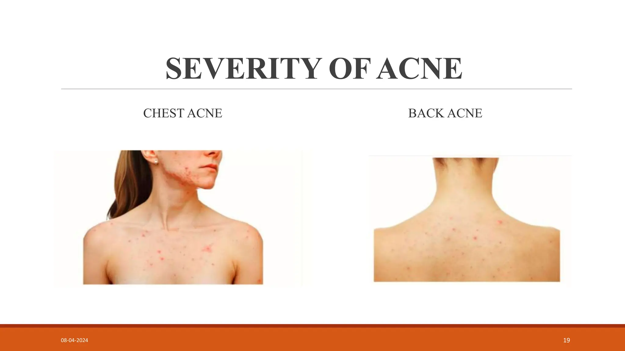 SEVERITY OFACNE
CHEST ACNE BACK ACNE
08-04-2024 19
 