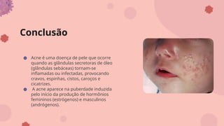 Conclusão
● Acne é uma doença de pele que ocorre
quando as glândulas secretoras de óleo
(glândulas sebáceas) tornam-se
inflamadas ou infectadas, provocando
cravos, espinhas, cistos, caroços e
cicatrizes.
● A acne aparece na puberdade induzida
pelo início da produção de hormônios
femininos (estrógenos) e masculinos
(andrógenos).
 