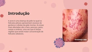 Introdução
A acne é uma doença da pele na qual os
folículos pilosos apresentam excesso de
gordura e células da pele mortas. As áreas
mais afectadas são a face, pescoço, peito,
costas e ombros, uma vez que é nestas
regiões que existe maior concentração de
folículos sebáceos.
 