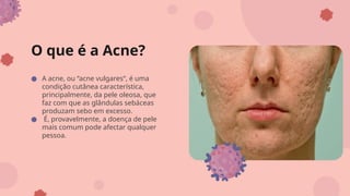 O que é a Acne?
● A acne, ou “acne vulgares“, é uma
condição cutânea característica,
principalmente, da pele oleosa, que
faz com que as glândulas sebáceas
produzam sebo em excesso.
● É, provavelmente, a doença de pele
mais comum pode afectar qualquer
pessoa.
 
