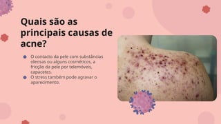 Quais são as
principais causas de
acne?
● O contacto da pele com substâncias
oleosas ou alguns cosméticos, a
fricção da pele por telemóveis,
capacetes.
● O stress também pode agravar o
aparecimento.
 