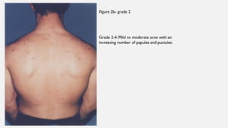 Acne- pathophysiology and types of acne. | PPTX