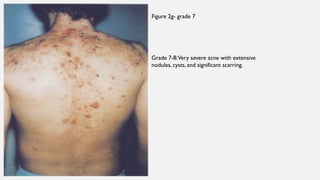 Acne- pathophysiology and types of acne. | PPTX