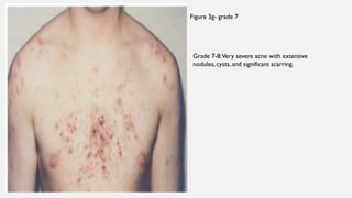 Acne- pathophysiology and types of acne. | PPTX