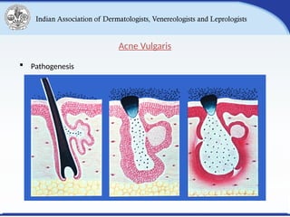 Acne Vulgaris and its Classification.pptx