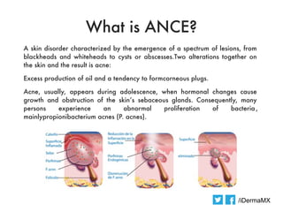 What is ANCE?
A skin disorder characterized by the emergence of a spectrum of lesions, from
blackheads and whiteheads to cysts or abscesses.Two alterations together on
the skin and the result is acne: 

Excess production of oil and a tendency to formcorneous plugs.

Acne, usually, appears during adolescence, when hormonal changes cause
growth and obstruction of the skin’s sebaceous glands. Consequently, many
persons    experience     an     abnormal    proliferation of    bacteria ,
mainlypropionibacterium acnes (P. acnes).




                                                                      /iDermaMX
 