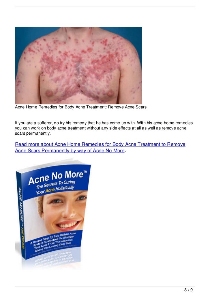 Acne Home Remedies for Body Acne Treatment Remove Acne Scars Now