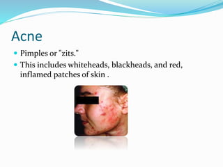 Acne
 Pimples or "zits."
 This includes whiteheads, blackheads, and red,
inflamed patches of skin .
 