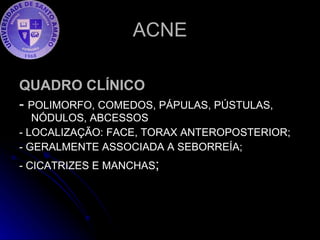 ACNE QUADRO CLÍNICO -  POLIMORFO, COMEDOS, PÁPULAS, PÚSTULAS, NÓDULOS, ABCESSOS - LOCALIZAÇÃO: FACE, TORAX ANTEROPOSTERIOR; - GERALMENTE ASSOCIADA A SEBORREÍA; - CICATRIZES E MANCHAS ; 