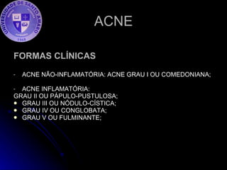 ACNE FORMAS CLÍNICAS ACNE NÃO-INFLAMATÓRIA: ACNE GRAU I OU COMEDONIANA; ACNE INFLAMATÓRIA:  GRAU II OU PÁPULO-PUSTULOSA; GRAU III OU NÓDULO-CÍSTICA; GRAU IV OU CONGLOBATA; GRAU V OU FULMINANTE; 