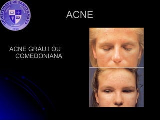 ACNE ACNE GRAU I OU COMEDONIANA 