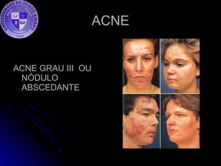 ACNE ACNE GRAU III  OU NÓDULO ABSCEDANTE  