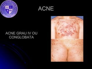 ACNE ACNE GRAU IV OU CONGLOBATA  