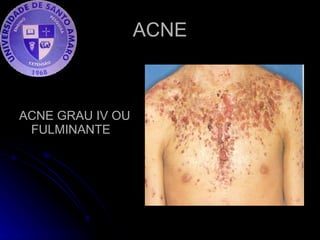 ACNE ACNE GRAU IV OU FULMINANTE 