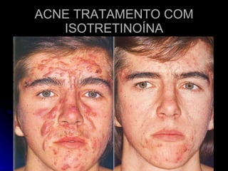 ACNE TRATAMENTO COM ISOTRETINOÍNA 
