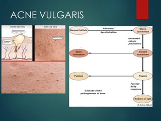 ACNE AND ACNEIFORM ERUPTIONS presentation II.pptx