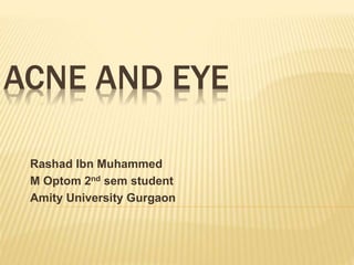 ACNE AND EYE
Rashad Ibn Muhammed
M Optom 2nd sem student
Amity University Gurgaon
 