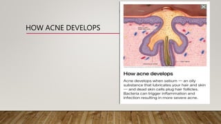 Acne And Its Medication.pptx
