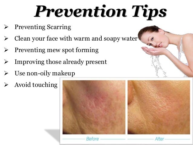 pustule acne treatment