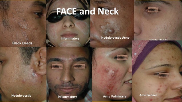 Acne Treatment. What is New?