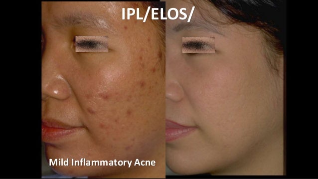 Acne Treatment. What is New?