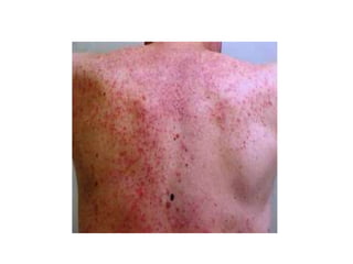 acneiform lesions.pptx