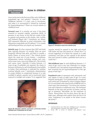 S57
Indian J Dermatol Venereol Leprol | January-February 2009 | Vol 75 | Supplement 1
Acne in India: Guidelines for management
Acne in children
Acne in children
Acnecanbeseeninthefirstyearoflife,earlychildhood,
prepubertal age, and puberty.[1]
However, in mid-
childhood, between 1–7 years, acne is uncommon,
and when it is encountered it should be evaluated
for hyperandrogenism.[2]
There are several subsets in
childhood acne.
Neonatal acne: It is actually not acne. It has been
renamed as neonatal cephalic pustulosis (NCP). It
presents in new borns, in the first few weeks of life,
as papules and pustules on the cheeks, chin, eyelids,
and forehead [Figure 66].[1]
Comedones are absent.
NCP represents follicular or poral colonization with
Malassezia sympodialis and M. globosa.[3]
It is usually
self-limiting and does not require any treatment.
Infantile acne: It is less common than NCP and starts
later, typically between 3–6 months. Boys are more
frequently affected than girls, and there is usually a
family history of severe acne.[4]
The clinical picture
shows the usual mix of acne lesions – comedones,
inflammatory lesions including nodules and cysts,
and in some cases, even scars [Figure 67]. The severity
and course varies. Typically it remits between 1–2
years of age. If antibiotics are required, the choice is
between erythromycin and trimethoprim (unavailable
in India). Oral isotretinoin is indicated for nodular/
scarring infantile acne.[5]
Isotretinoin administration
in young children is complicated because it is only
available in gelatin capsules and is inactivated when
exposed to sunlight and oxygen.[5]
It is suggested that
capsules should be opened in dim light and mixed
with butter and jam and spread on a bread slice.[5]
A
second suggestion is to freeze the capsule to a solid
consistency and then cut the capsule to the desired
dose and conceal it within a palatable food such as a
candy bar.[5]
Mid-childhood acne: In mid-childhood between 1–7
years of age, acne is very rare. Clinically it is similar
to infantile acne, but denotes hyperandrogenism. The
best screening test for hyperandrogenism in this age
group is bone age.[2]
Prepubertal acne: It represents early adrenarche and
may appear as early as eight years of age. It is more
frequent among girls.[1]
It is predominantly comedonal
and central part of forehead is where it begins [Figure
9]. It is associated with raised levels of DHEAS and, in
some cases, free testosterone.[1]
It evolves into common
acne and continues as adolescent acne. The treatment
depends on the type and severity of lesions, and the
age at treatment. Macrolides are the treatment of
choice. Tetracyclines may be given above the age of
eight years, although some experts draw the line at 10
years. Cephalexin is an option in the below 8-years
age group.[6]
REFERENCES
REFERENCES
1. Cantatore-Francis JL, Glick SA. Childhood acne: Evaluation
and management. Dermatol Ther 2006;19:202-9.
2. Lucky AW. A review of infantile and pediatric acne.
IAA Consensus
Document
Figure 67: Varioliform scars from infantile acne
Figure 66: Neonatal cephalic pustulosis, previously termed
neonatal acne. Comedones are not seen
 