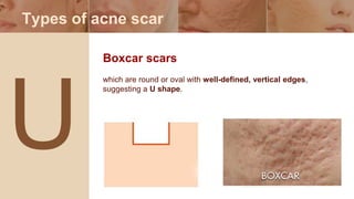 Practical guideline for the acne management | PPTX