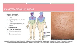 MANIFESTACIONES CLÍNICAS
 TOPOGRAFÍA:
 Cara
 Región superior del tronco
( 61%)
 Cuello, región superior de
brazos
 LESIONES NO
INFLAMATORIAS
 Comedones cerrados
 Comedones abiertos
+ frecuente
Frecuente
Infrecuente
Raro
Zaenglein A, Thiboutot D. Acné vulgar. En: Bolognia J, Schaffer J, Cerroni L. Dermatología. 4ª ed. España: Elsevier; 2018. p.588-603. Thiboutot D, Zaenglein A. Pathogenesis,
clinical manifestations, and diagnosis of acne vulgaris. Dellavalle R, ed. UpToDate. O Ofori A: UpToDate Inc. https://www.uptodate.com (Accesado mayo 2020).
 
