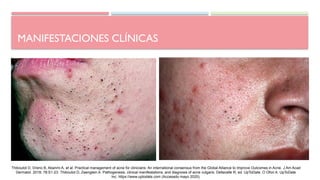 MANIFESTACIONES CLÍNICAS
Thiboutot D, Dreno B, Abanmi A, et al. Practical management of acne for clinicians: An international consensus from the Global Alliance to Improve Outcomes in Acne. J Am Acad
Dermatol. 2018; 78:S1-23. Thiboutot D, Zaenglein A. Pathogenesis, clinical manifestations, and diagnosis of acne vulgaris. Dellavalle R, ed. UpToDate. O Ofori A: UpToDate
Inc. https://www.uptodate.com (Accesado mayo 2020).
 