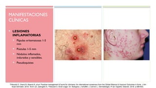 MANIFESTACIONES
CLÍNICAS
 LESIONES
INFLAMATORIAS
 Pápulas eritematosas 1-5
mm
 Pústulas 1-5 mm
 Nódulos inflamados,
indurados y sensibles.
 Pseudoquistes
Thiboutot D, Dreno B, Abanmi A, et al. Practical management of acne for clinicians: An international consensus from the Global Alliance to Improve Outcomes in Acne. J Am
Acad Dermatol. 2018; 78:S1-23. Zaenglein A, Thiboutot D. Acné vulgar. En: Bolognia J, Schaffer J, Cerroni L. Dermatología. 4ª ed. España: Elsevier; 2018. p.588-603.
 