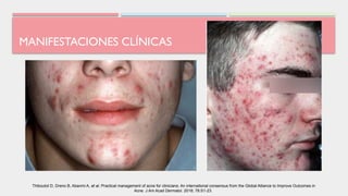 MANIFESTACIONES CLÍNICAS
Thiboutot D, Dreno B, Abanmi A, et al. Practical management of acne for clinicians: An international consensus from the Global Alliance to Improve Outcomes in
Acne. J Am Acad Dermatol. 2018; 78:S1-23.
 