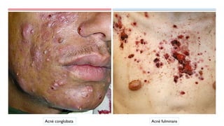 Acné conglobata Acné fulminans
 