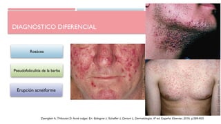 DIAGNÓSTICO DIFERENCIAL
Rosácea
Zaenglein A, Thiboutot D. Acné vulgar. En: Bolognia J, Schaffer J, Cerroni L. Dermatología. 4ª ed. España: Elsevier; 2018. p.588-603
Pseudofoliculitis de la barba
Erupción acneiforme
 