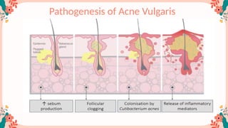 Acne vulgaris guideline for women (2).pptx